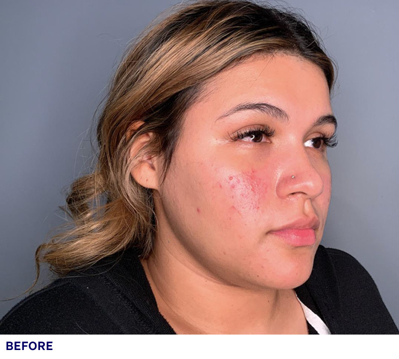 Cosmetic Services - ADVANTx Laser: Before & After