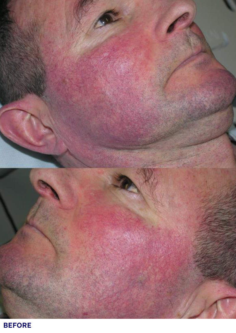 Cosmetic Services - ADVATx Laser: Before & After