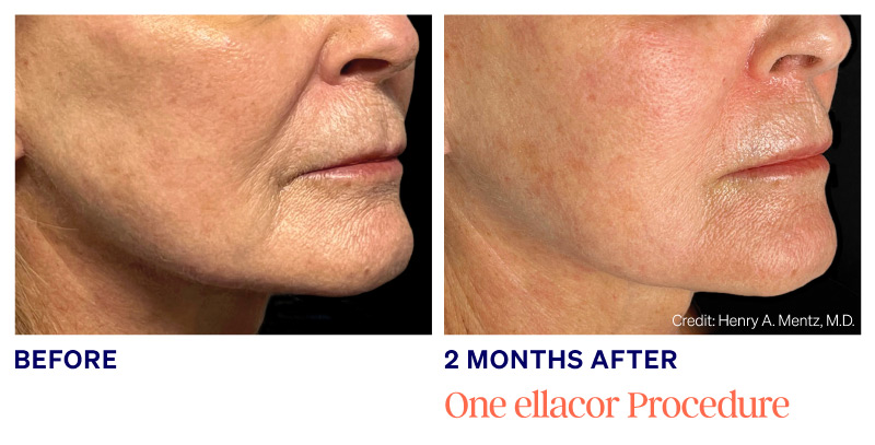 Cosmetic Services - Ellacor Skin Tightening: Before & After