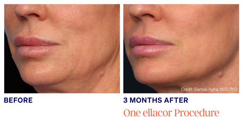 Cosmetic Services - Ellacor Skin Tightening: Before & After